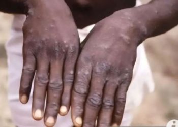 79 Vaksin Cacar Monyet Di Jakarta Sudah Diberikan, Sleman Sosialisasi Hidup Bersih