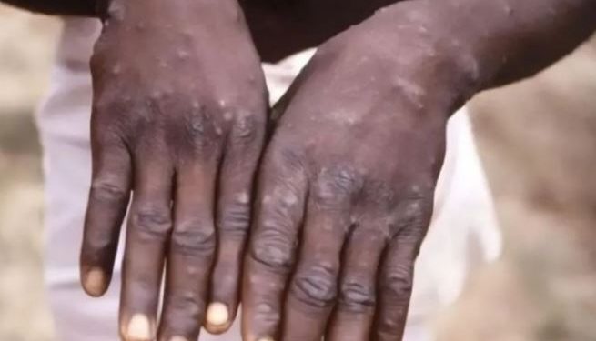 79 Vaksin Cacar Monyet Di Jakarta Sudah Diberikan, Sleman Sosialisasi Hidup Bersih